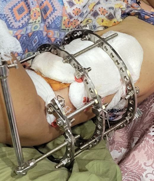 这种类型的框架用于治疗骨骼，它被称为“伊利扎洛夫技术”。该技术用于矫正先天性畸形骨、骨折和骨延长缩略图