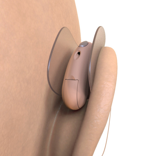 柔性助听器缩略图